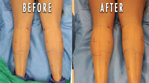Build Bigger Calves With Fat Grafting Youtube