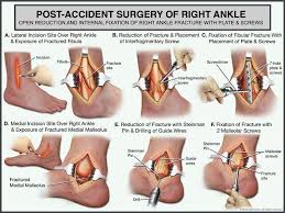 Pin On Everything Orthopaedic