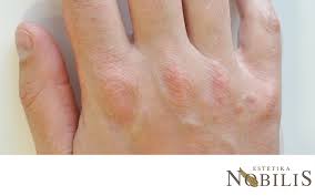Typischerweise bilden sich vulgäre warzen im gesicht, an den fingern und unter der nagelplatte. Viruswarzen Estetika Nobilis