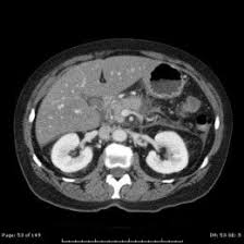 Ct scans can show a. Pin On Health