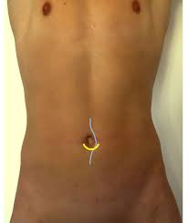 Man muss dem heilungsverlauf auch die nötige zeit geben. Nabelbruch Op In Nurnberg Klinik Hallerwiese De