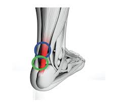 Check spelling or type a new query. Achilles Tendinopathy Ultrasound Guided Injections