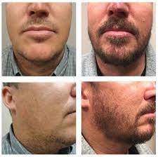 Contact our newport beach office to schedule a consultation for facial hair transplant surgery. Facial Hair Transplant Newport Beach Beard Implant Dr Varona