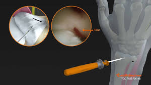 Chronic tfcc injuries are seen in older athletes and represent a continuum of injury and degeneration. Tfcc Fast Fix Tech Animation Youtube