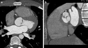 Image result for XRay Changes in Rheumatic Conditions