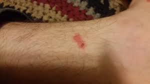 Chiggers are tiny, only about 1/100 of a millimeter in size and only bite people when they're in the larva stage. Chiggers 484184 Ask Extension