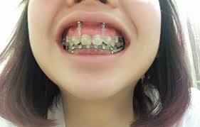 Gummy smile live webinar using tads miniscrews in orthodontics. My Braces Story 3 Second And Final Stage Put On 4 Screws Chanwon Com Travel Beauty Blogger