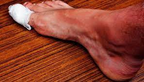 Les ongles incarnés sont douloureux et peuvent même nécessiter une ablation chirurgicale s'ils deviennent graves. Ongle Incarne Comment S En Debarrasser Pied Zen
