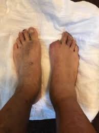 Image result for toe amputation