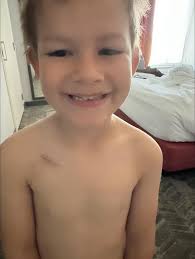 Every scar tells a story 🧡🎗️ Port removal ✔️ Post treatment life  activated.