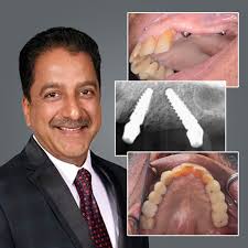 Want to learn how to tackle implants in the posterior maxilla? Learn from… 