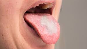 Image result for Oral thrush roof of mouth