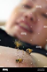 A patient receives bee venom therapy