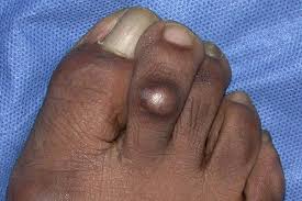 Image result for brown patches on the feet