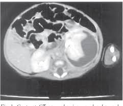 Image result for Perinephric Abscess