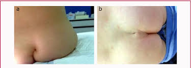 Image result for Spinal Dysraphism