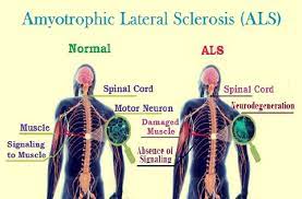 Amyotrophic lateral sclerosis (als) is a degenerative disease that affects the brain and spinal cord. Pin On Neuroscience