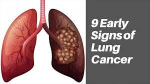 In the early stages, people often do not see any signs of lung cancer; 9 Early Signs Of Lung Cancer Boxym Com