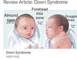 Nejm On Twitter Review Article Down Syndrome
