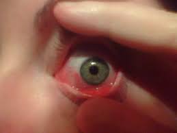 When Waking Up Isn T Pretty Dry Eyes In The Morning Eyeeco Blog