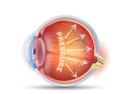 Image result for Intraocular Pressure