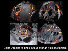 (a) multilocular solid ovarian serous adenocarcinoma with increased vascularity. Uog Video Clip Ultrasound Features Of Malignant Ovarian Yolk Sac Tumors Anfelter Youtube