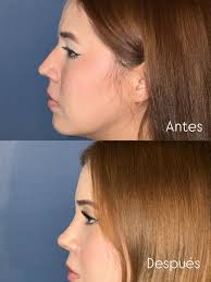 CIRUGIA PLASTICA FACIAL (@dr.cordero.chacon) · Tampico