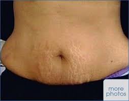 Celebrity Stretch Marks Beauty Health Beauty Hacks Homemade Beauty