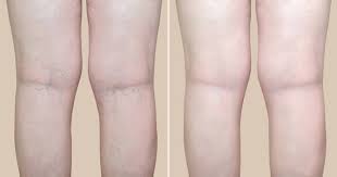 We did not find results for: Benefits Of Laser Vein Treatment Core Medical Wellness