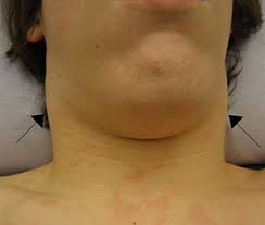 Spesso ha una sintomatologia lieve, ma talvolta può comportare seri rischi. Infectious Mononucleosis Wikipedia