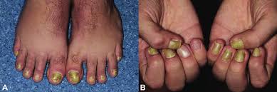 Image result for Yellow nail syndrome feet