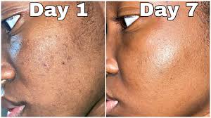 Apple cider vinegar is fermented juice from crushed apples. One Week Of Apple Cider Vinegar On My Face To Get Rid Of Dark Spots Acne Scars Shocking Results Youtube