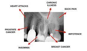 Root Cause On Netflix Can Root Canals Make You Sick Dentistry Today