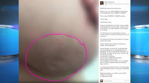 In its early stages, breast cancer usually does not cause pain and may exhibit no noticeable symptoms. Dimpling Of Breast Skin Not Cancer This Woman S Breast Dimpling Was Her Only Sign Of Breast Cancer