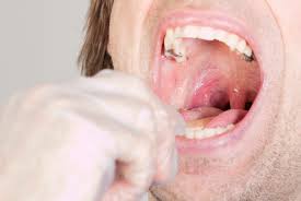 Image result for Pharyngitis