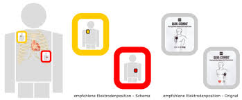 The magical defibrillator trope as used in popular culture. Praxisanleitung Externe Defibrillation Durchfuhren Aed Virtuelle San Arena Erlangen