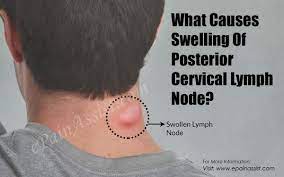 We did not find results for: What Causes Swelling Of Posterior Cervical Lymph Node How Is It Treated