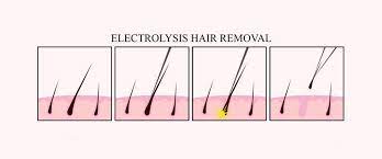 There are a couple different types of electrolysis. Is Electrolysis Hair Removal Painful 2pass Clinic
