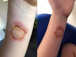 What does a bite look like? Mum S False Widow Spider Warning After Daughter Suffers Horror Bite Birmingham Live