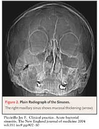 Sinusitis Cancer Therapy Advisor
