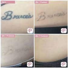 Sometimes, complete removal of a tattoo can take one or two years, with treatments occurring every 6, 8, or 12 weeks. Laser Tattoo Removal Before And After Photos Premium Tattoo Removal