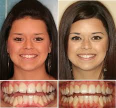 Dr Ginger Price Elite Invisalign Provider Before And After Photos Ph 602 468 1135 Www Gingerpricedds Com Teeth Straightening Dental Braces Dentaltown