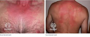 Image result for Scombroid Fish Poisoning