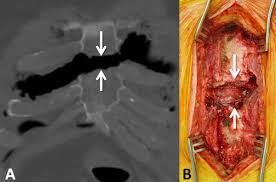 Image result for Sternal Fracture