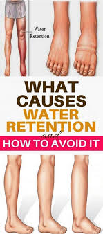 What Causes Water Retention And How To Avoid It Water Retention Water Retention Remedies Good Health Tips