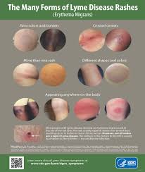 Image result for infected tick bite