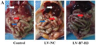 Explore how ctca diagnoses and treats metastatic cancer. B7 H3 Overexpression In Pancreatic Cancer Promotes Tumor Progression