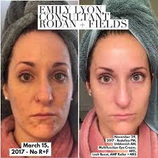 BeautyBio R45 The Reversal The product is a multi-phase retinol treatment  system designed to address signs of aging. It uses a patented 3-phase  system to gradually increase retinol concentration over a 45-day