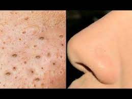 Você está fazendo tudo certo em termos de estilo de vida e dieta, mas o que eu acho que é necessário aqui é o tratamento adequado sob a forma de antibióticos. Como Remover Cravos Do Nariz Em Minutos 4 Tecnicas Caseiras Por Junia Gabriela Youtube