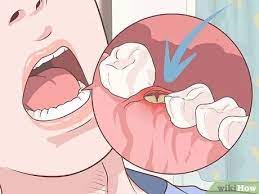 How To Heal Gums After A Tooth Extraction Tooth Extraction Tooth Extraction Healing After Wisdom Teeth Removal